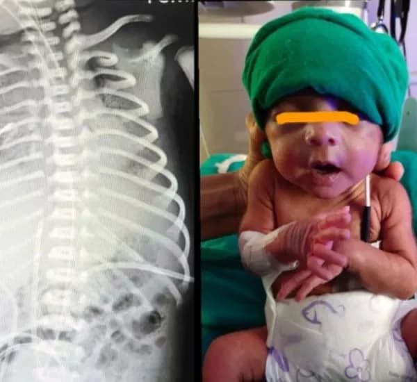 A baby girl with serve rds and pnumothorax